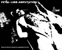 Fetal Limb Amputation